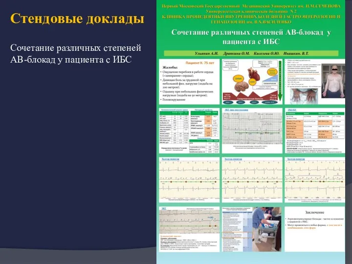 Стендовые доклады Сочетание различных степеней АВ-блокад у пациента с ИБС