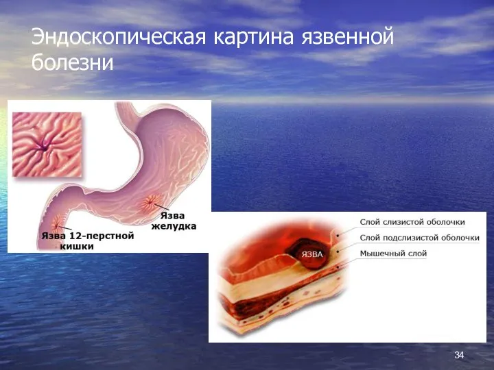 Эндоскопическая картина язвенной болезни