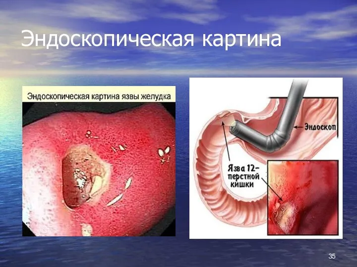 Эндоскопическая картина