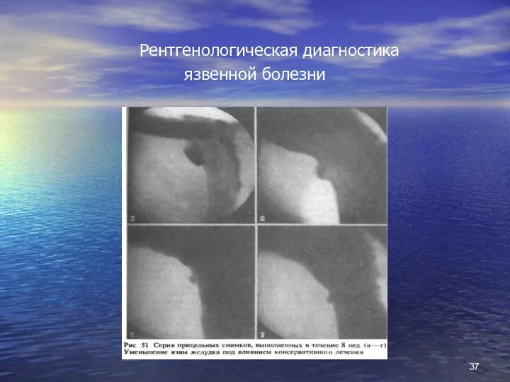 Рентгенологическая диагностика язвенной болезни