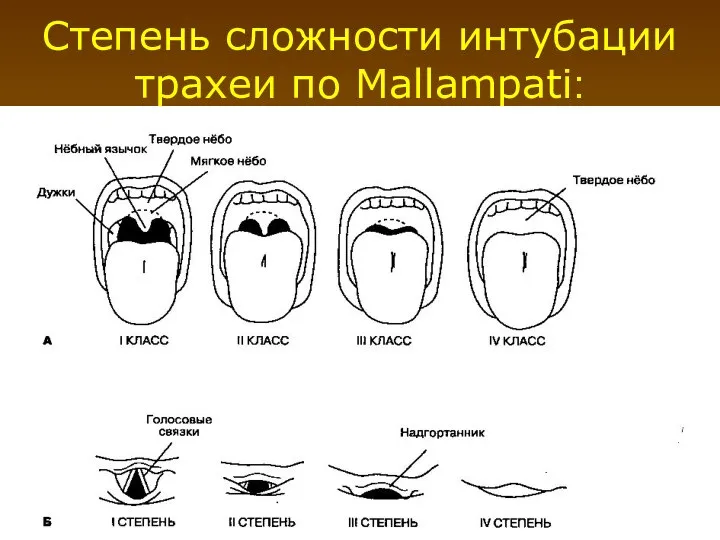 Степень сложности интубации трахеи по Mallampati: