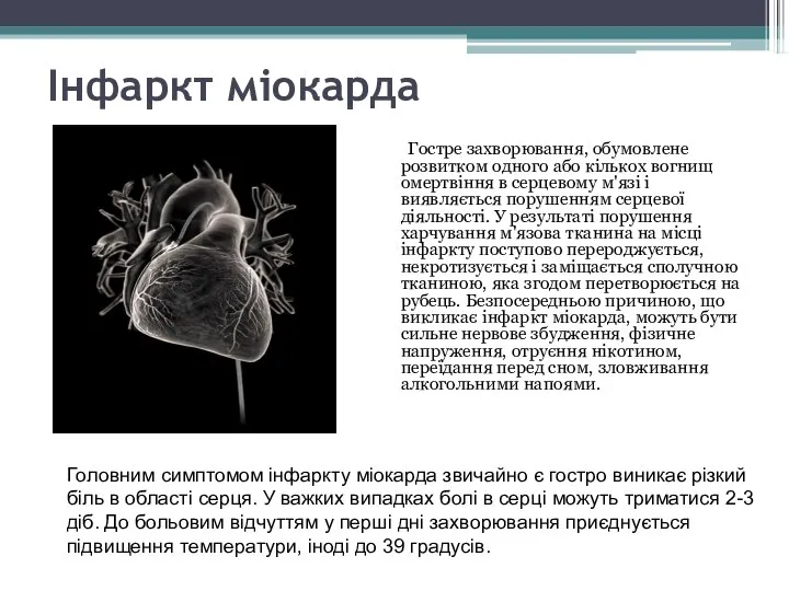 Інфаркт міокарда Гостре захворювання, обумовлене розвитком одного або кількох вогнищ омертвіння