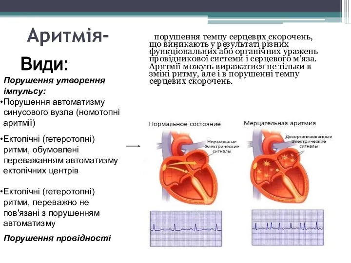 Аритмія- порушення темпу серцевих скорочень, що виникають у результаті різних функціональних