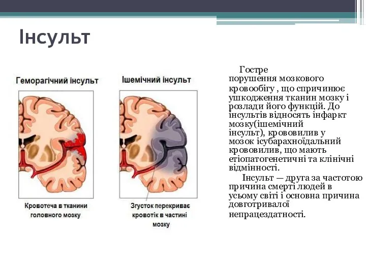 Інсульт Гостре порушення мозкового кровообігу , що спричинює ушкодження тканин мозку