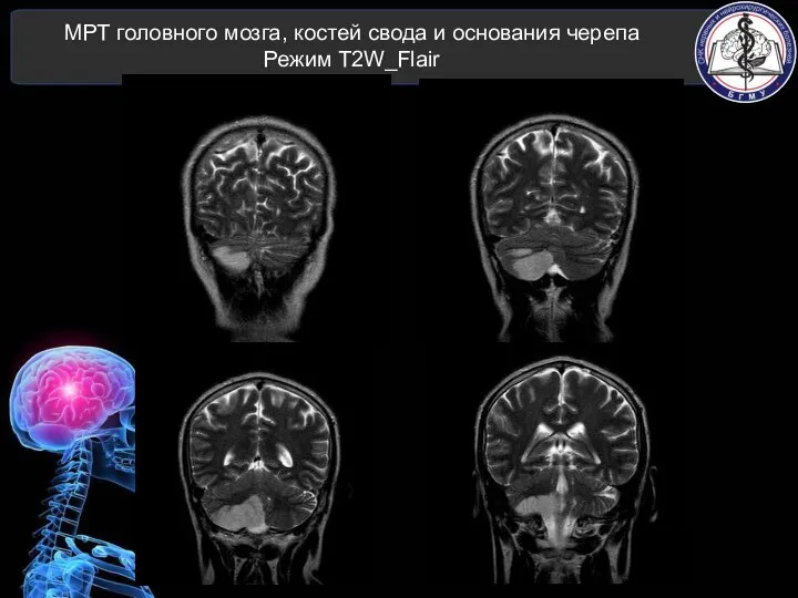 МРТ головного мозга, костей свода и основания черепа Режим T2W_Flair