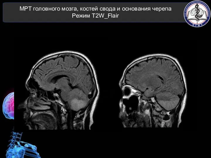 МРТ головного мозга, костей свода и основания черепа Режим T2W_Flair