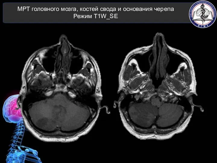 МРТ головного мозга, костей свода и основания черепа Режим T1W_SE