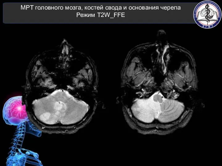 МРТ головного мозга, костей свода и основания черепа Режим T2W_FFE