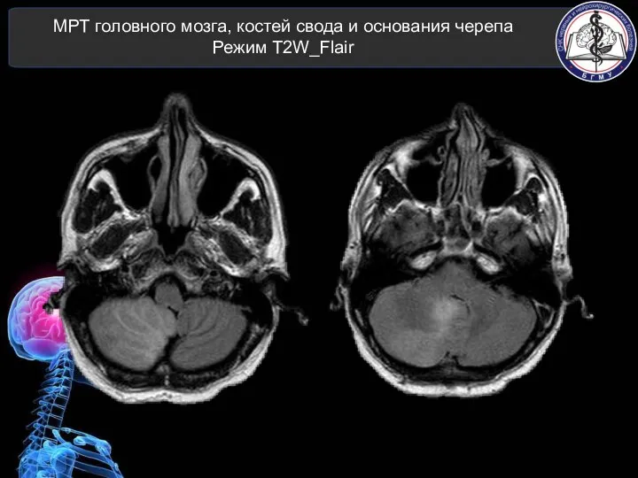 МРТ головного мозга, костей свода и основания черепа Режим T2W_Flair