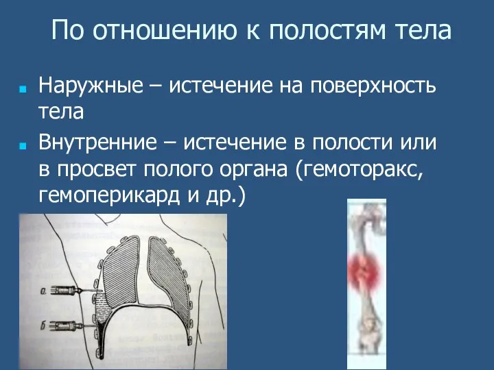 По отношению к полостям тела Наружные – истечение на поверхность тела