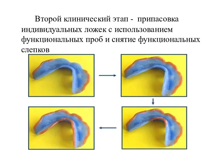 Второй клинический этап - припасовка индивидуальных ложек с использованием функциональных проб и снятие функциональных слепков