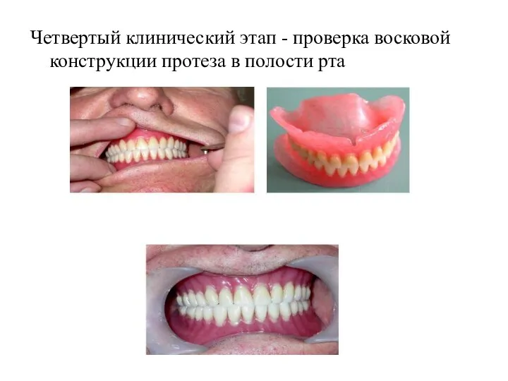 Четвертый клинический этап - проверка восковой конструкции протеза в полости рта