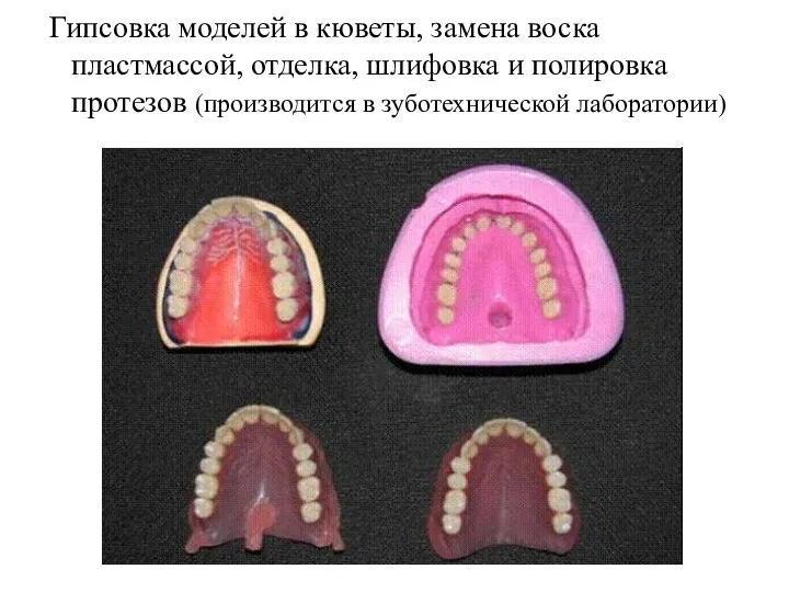 Гипсовка моделей в кюветы, замена воска пластмассой, отделка, шлифовка и полировка протезов (производится в зуботехнической лаборатории)