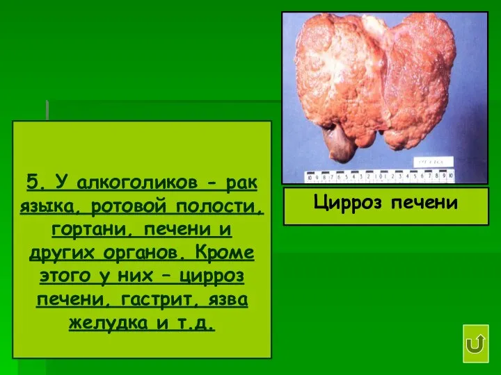 5. У алкоголиков - рак языка, ротовой полости, гортани, печени и