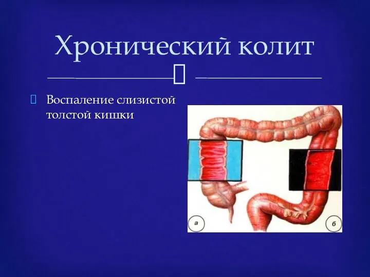 Хронический колит Воспаление слизистой толстой кишки