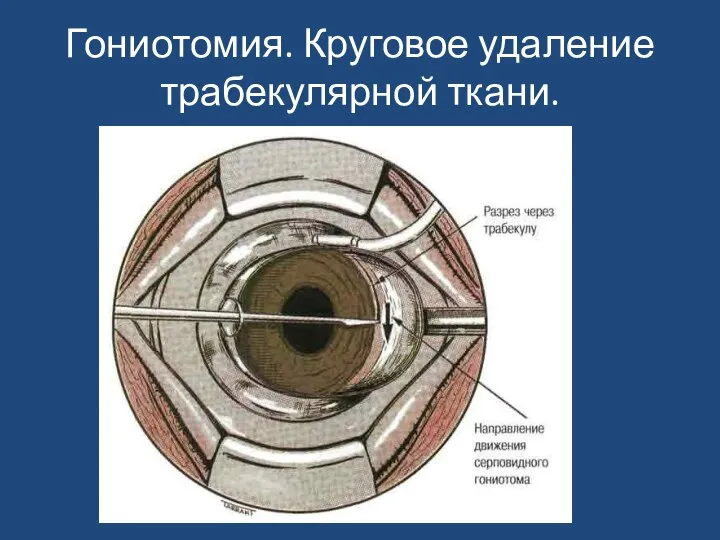 Гониотомия. Круговое удаление трабекулярной ткани.