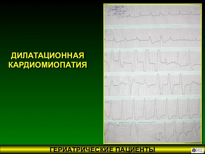 ДИЛАТАЦИОННАЯ КАРДИОМИОПАТИЯ