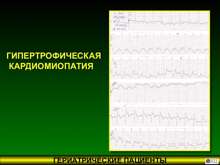 ГИПЕРТРОФИЧЕСКАЯ КАРДИОМИОПАТИЯ