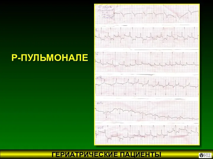 Р-ПУЛЬМОНАЛЕ