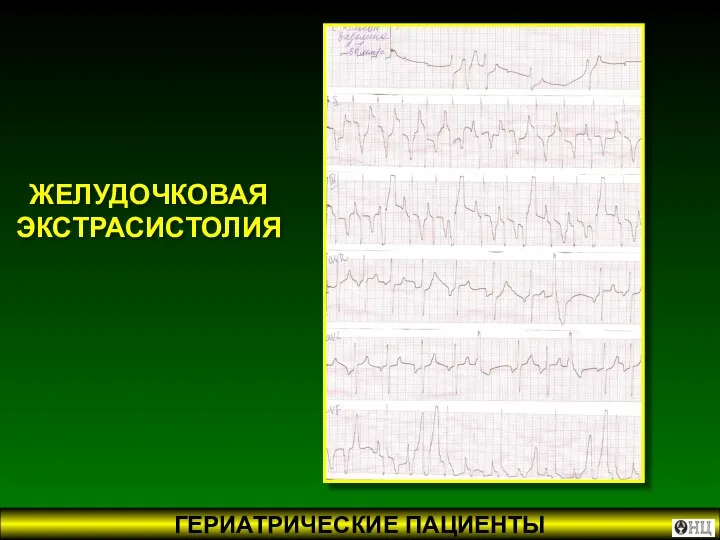 ЖЕЛУДОЧКОВАЯ ЭКСТРАСИСТОЛИЯ