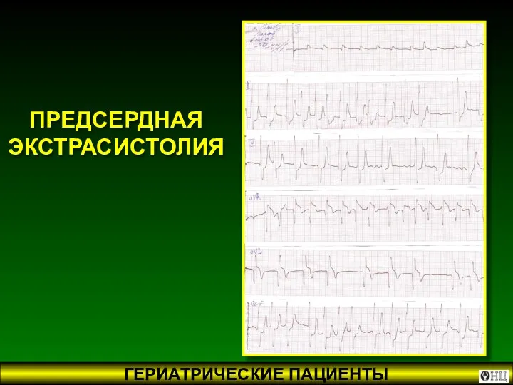 ПРЕДСЕРДНАЯ ЭКСТРАСИСТОЛИЯ