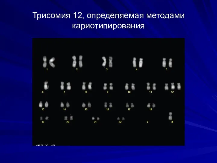 Трисомия 12, определяемая методами кариотипирования