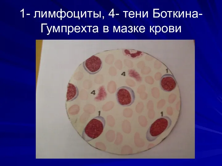 1- лимфоциты, 4- тени Боткина-Гумпрехта в мазке крови