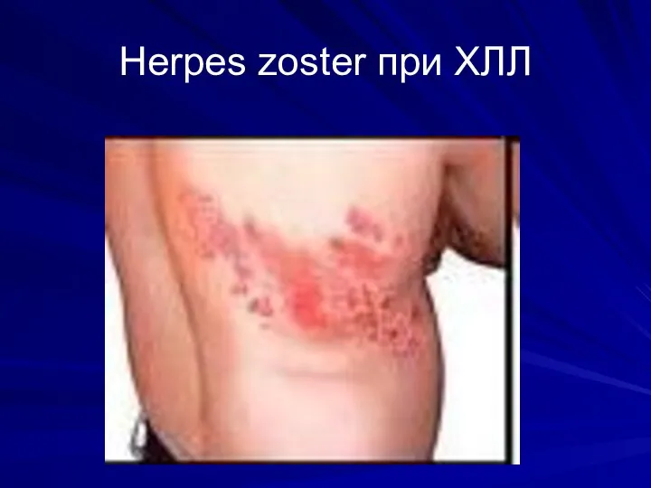 Herpes zoster при ХЛЛ