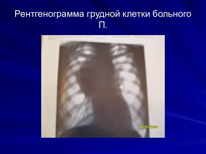 Рентгенограмма грудной клетки больного П.