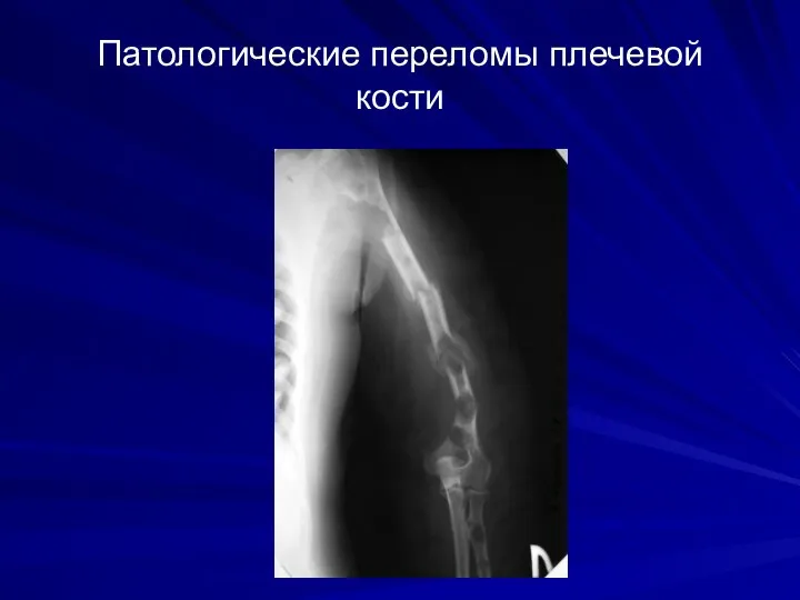 Патологические переломы плечевой кости