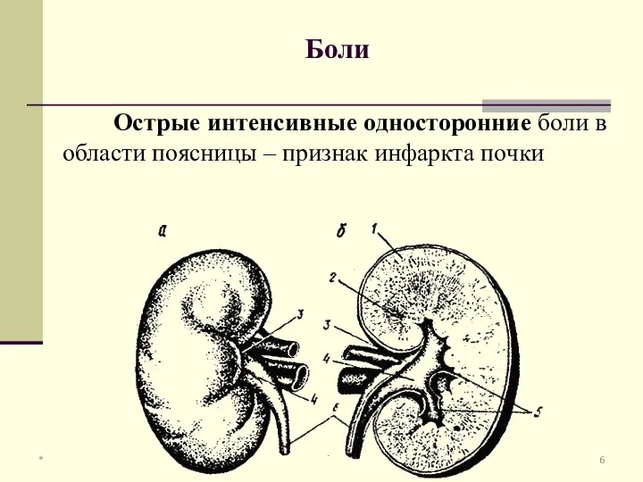 Боли Острые интенсивные односторонние боли в области поясницы – признак инфаркта почки *