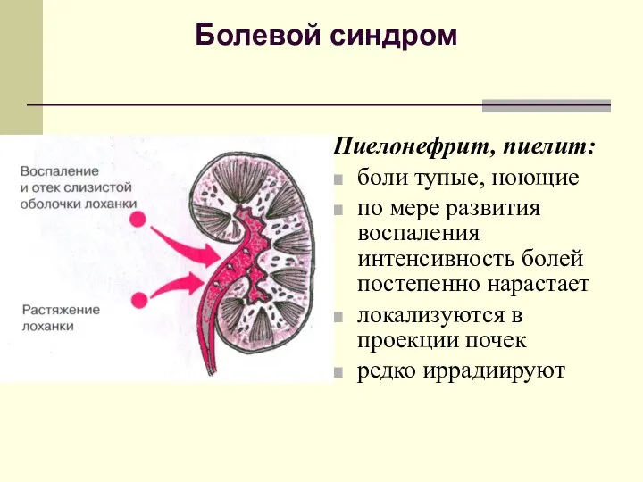 Болевой синдром Пиелонефрит, пиелит: боли тупые, ноющие по мере развития воспаления