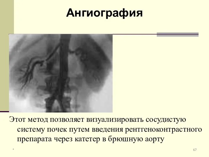 Этот метод позволяет визуализировать сосудистую систему почек путем введения рентгеноконтрастного препарата