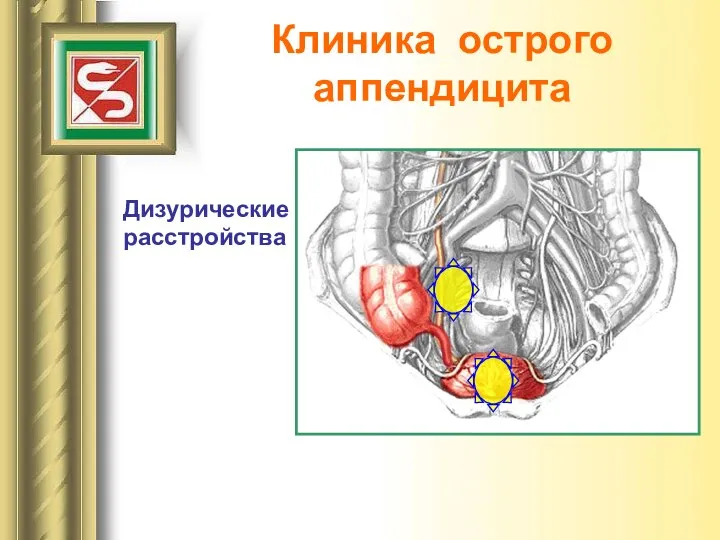 Клиника острого аппендицита Дизурические расстройства