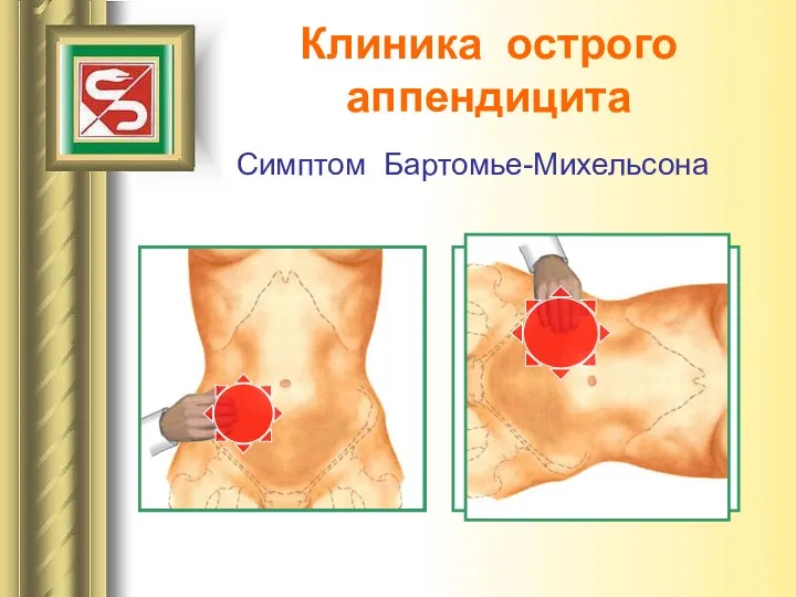 Клиника острого аппендицита Симптом Бартомье-Михельсона