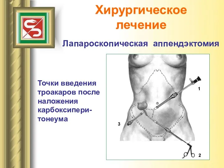 Хирургическое лечение Лапароскопическая аппендэктомия Точки введения троакаров после наложения карбоксипери-тонеума