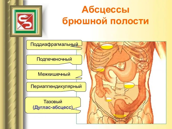 Абсцессы брюшной полости Поддиафрагмальный Подпеченочный Межкишечный Периаппендикулярный Тазовый (Дуглас-абсцесс)