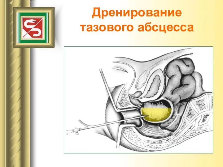 Дренирование тазового абсцесса