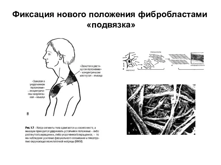 Фиксация нового положения фибробластами «подвязка»