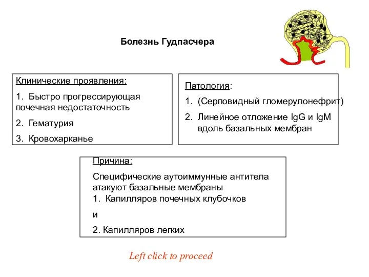 Болезнь Гудпасчера Причина: Специфические аутоиммунные антитела атакуют базальные мембраны 1. Капилляров