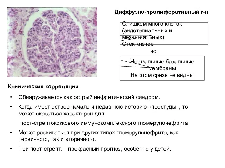 но Диффузно-пролиферативный г-н Слишком много клеток (эндотелиальных и мезангиальных) Отек клеток