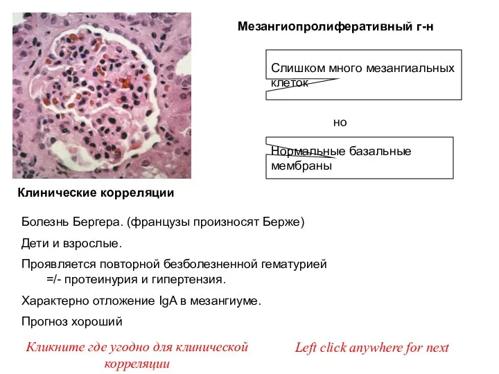 но Мезангиопролиферативный г-н Кликните где угодно для клинической корреляции Клинические корреляции