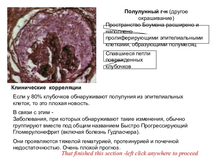 Полулунный г-н (другое окрашивание) Пространство Боумана расширено и наполнено пролиферирующими эпителиальными