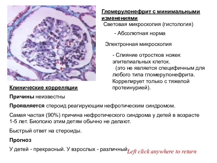 Гломерулонефрит с минимальными изменениями Световая микроскопия (гистология) Left click anywhere for