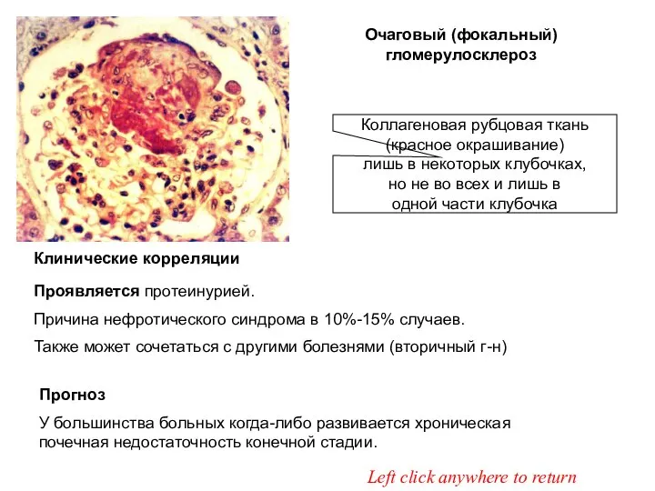 Очаговый (фокальный) гломерулосклероз Left click anywhere for clinical correlations Клинические корреляции