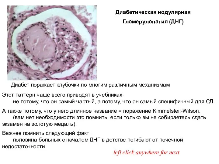 Диабетическая нодулярная Гломерулопатия (ДНГ) Диабет поражает клубочки по многим различным механизмам