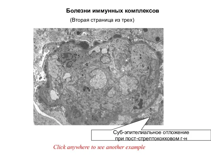 Болезни иммунных комплексов Суб-эпителиальное отложение при пост-стрептококковом г-н Click anywhere to