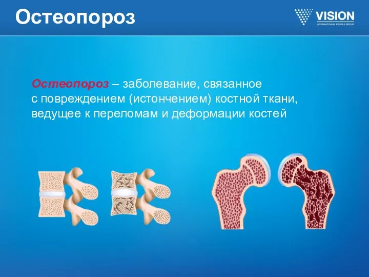 Остеопороз Остеопороз – заболевание, связанное с повреждением (истончением) костной ткани, ведущее к переломам и деформации костей