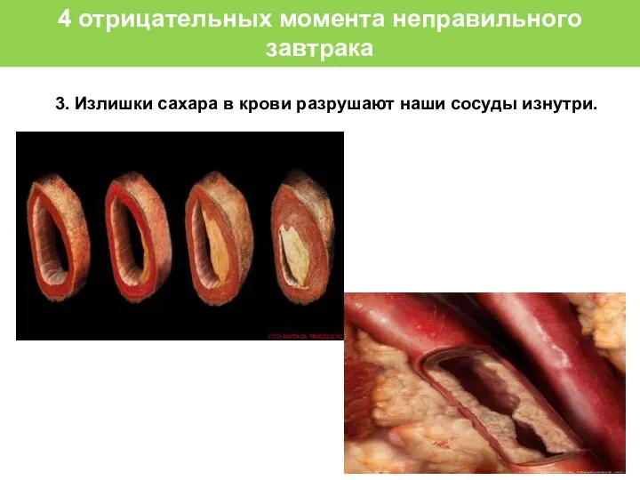 3. Излишки сахара в крови разрушают наши сосуды изнутри. 4 отрицательных момента неправильного завтрака