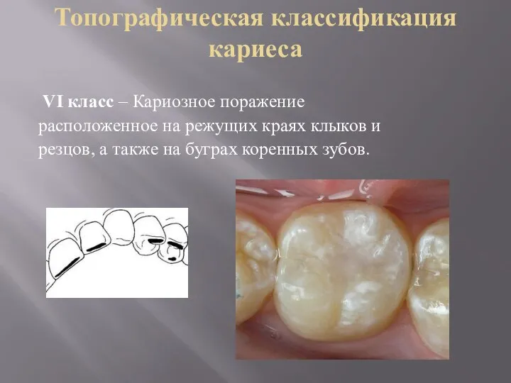 Топографическая классификация кариеса VI класс – Кариозное поражение расположенное на режущих